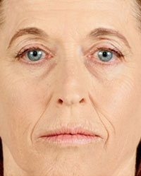 After Juvederm Voluma XC - First Photo