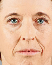 Before Juvederm Voluma XC - First Photo