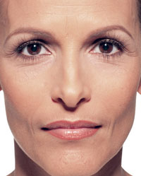 Before Juvederm - Third Photo