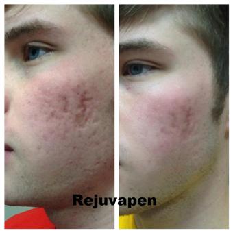 AcneFace